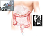 Ирригоскопия — методика исследования толстого кишечника
